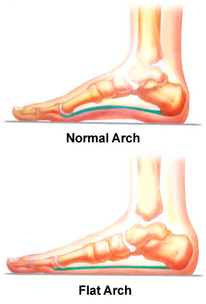 Flexible Flatfoot Flexible Flatfoot