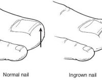 Normal Nail and Ingrown Nail