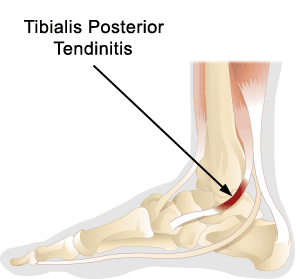 Painful Progressive Flatfoot also known as Tribialis Posterior Tendinitis