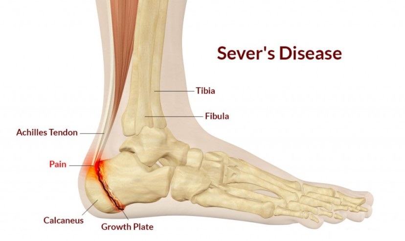 Sever’s Disease Sever’s Disease